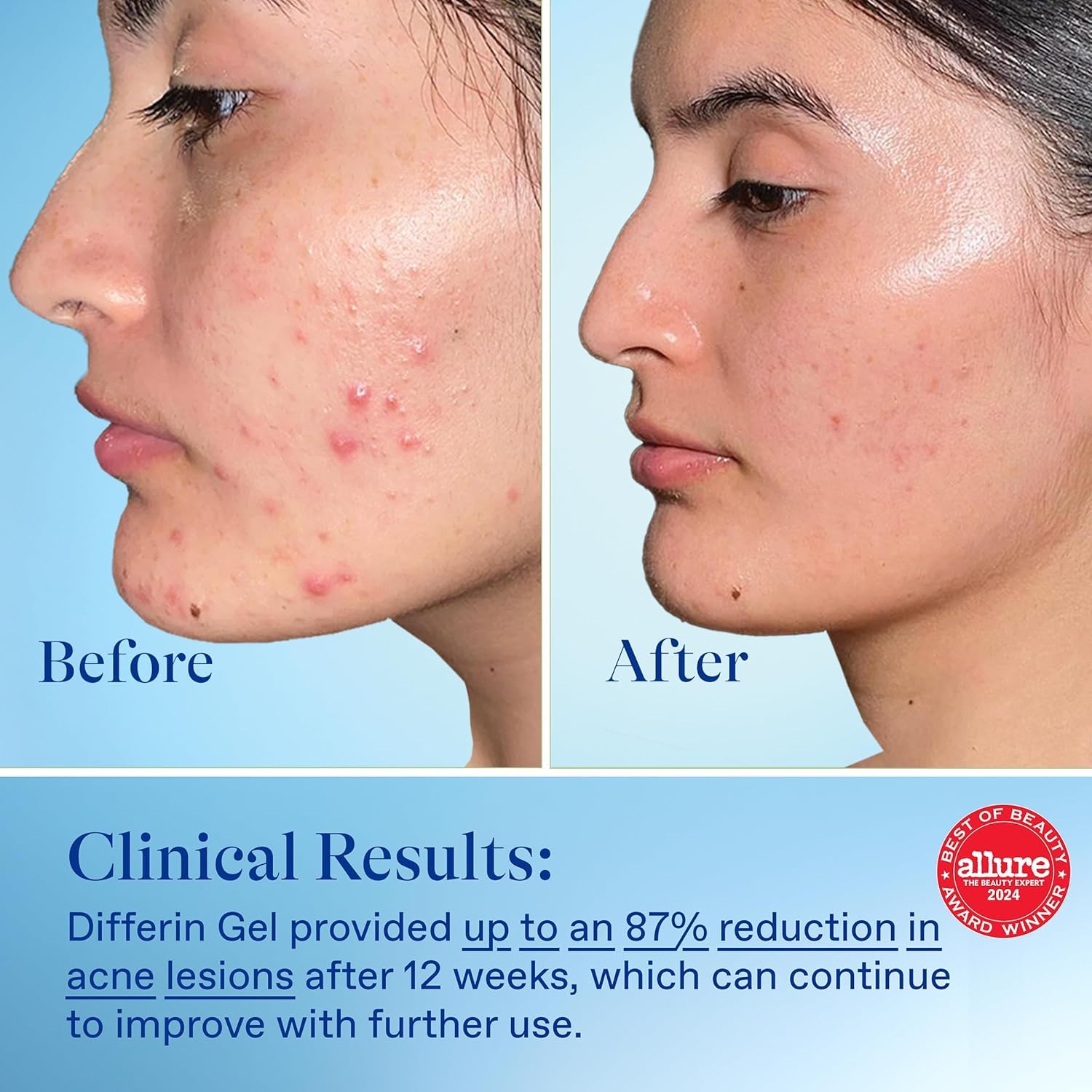 Differin Acne Treatment Gel, 180 Day Supply, Retinoid Treatment for Face with 0.1% Adapalene, Gentle Skin Care for Acne Prone Sensitive Skin, 45g , Pack of 2 (Packaging May Vary): Tube